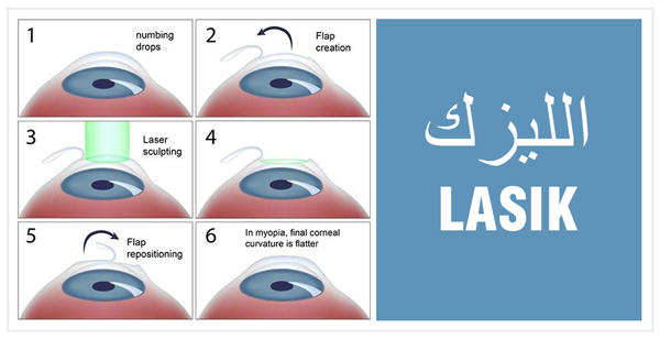 جراحة العيون بالليزك في الهند