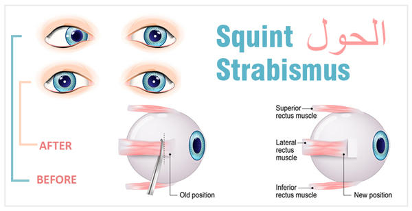 جراحة الحول في الهند