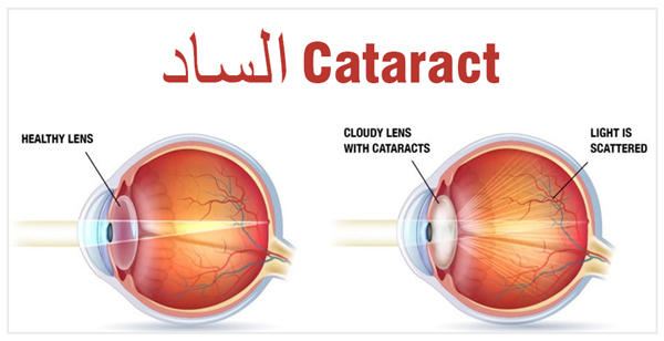 جراحة الساد في الهند