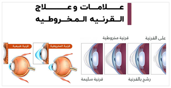 جراحة-القرنية-في-الهند