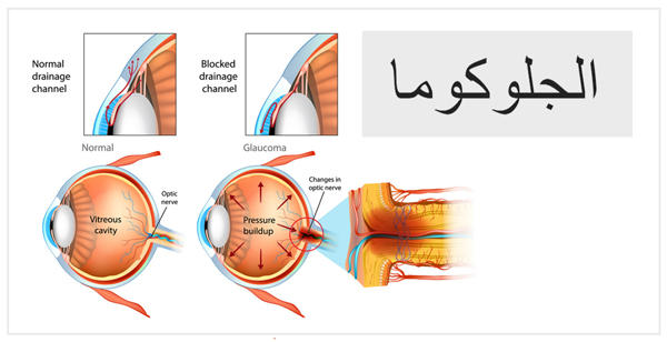 علاج-الجلوكوما-في-الهند-أو-جراحة-الجلوكوما-في-الهند
