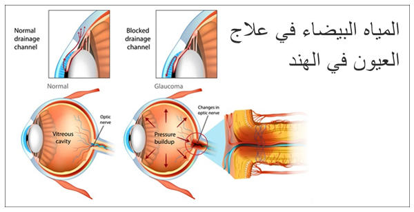 المياه-البيضاء-في-علاج-العيون-في-الهند