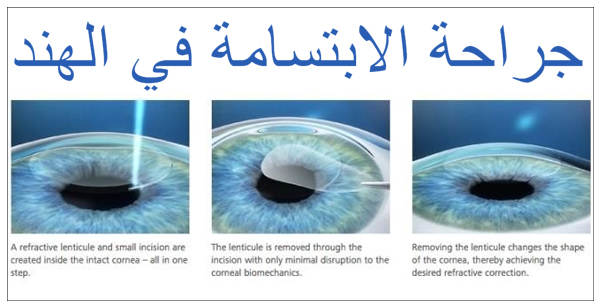 جراحة-الابتسامة-في-الهند