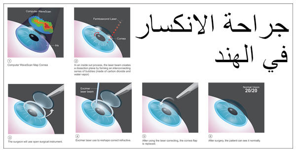 جراحة-الانكسار-في-الهند