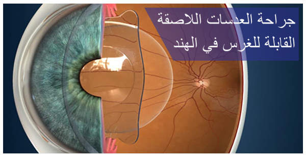 جراحة-العدسات-اللاصقة-القابلة-للغرس-في-الهند-(ICL)