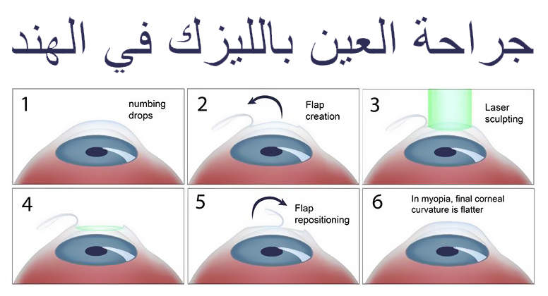 جراحة-العين-بالليزك-في-الهند-LASIK-EYE-SURGERY-IN-INDIA