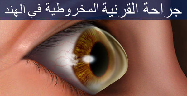 جراحة القرنية المخروطية في الهند