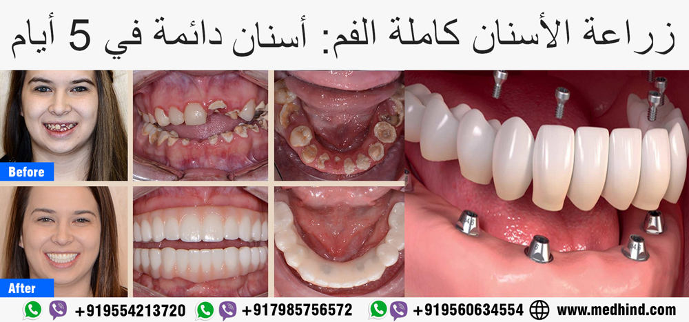 زراعة-الأسنان-كاملة-الف,-أسنان-دائمة-في-5-أيام