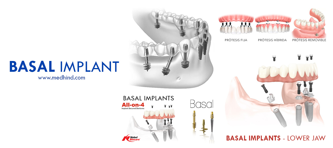 Basal-Implants-India---تكلفة-زراعة-القاعدية-في-الهند---قاعدية-في-الهند---زراعة-الأسنان-الهند