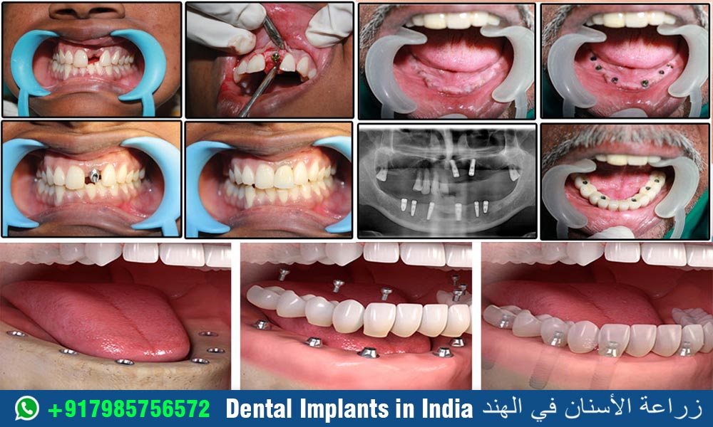Dental Implants in India-زراعة-الأسنان-في-الهند