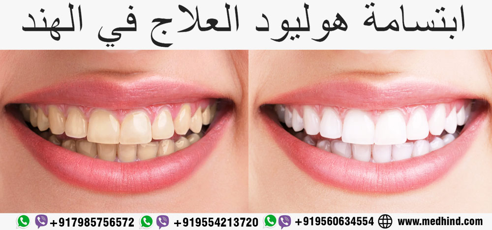 ابتسامة-هوليود-الهند---ابتسامة-هوليود-العلاج-في-الهند