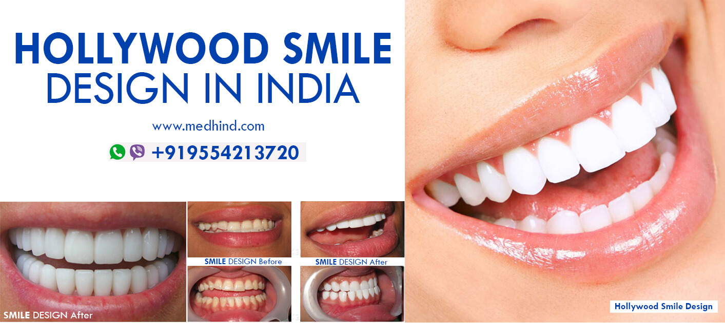 ابتسامة-هوليوود-الهند---ابتسامة-هوليوود-التصميم-في-الهند-،-ابتسامة-التصميم-hollywood-smile-india---hollywood-smile-design-in-india,-Smile-Design (1)