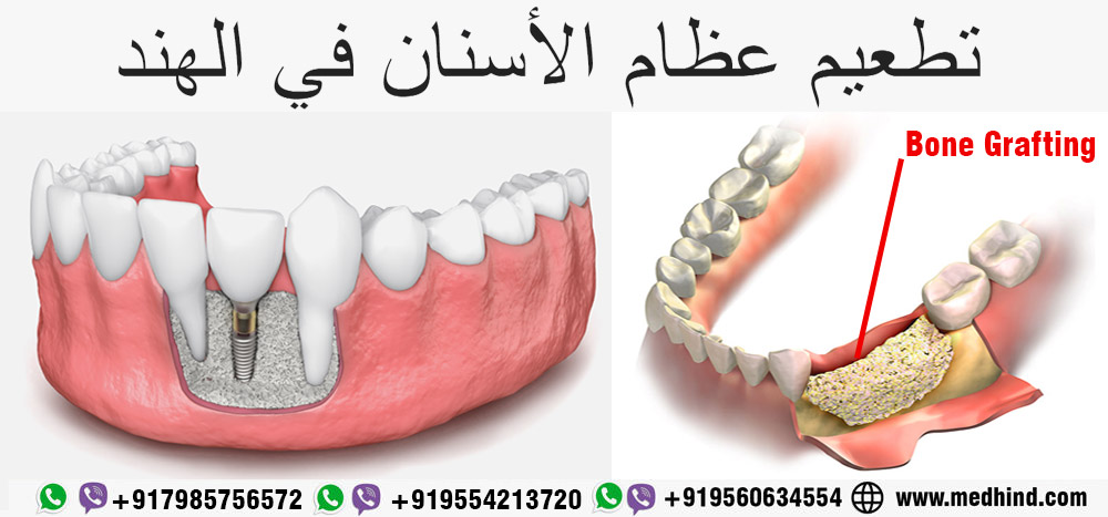 تطعيم العظام زراعة الاسنان الهند