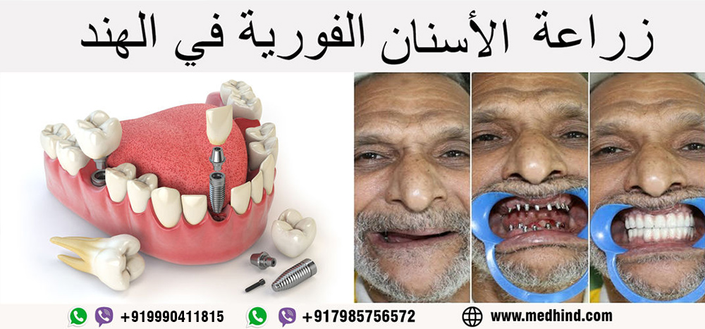 زراعة-الأسنان-الفورية-في-الهند