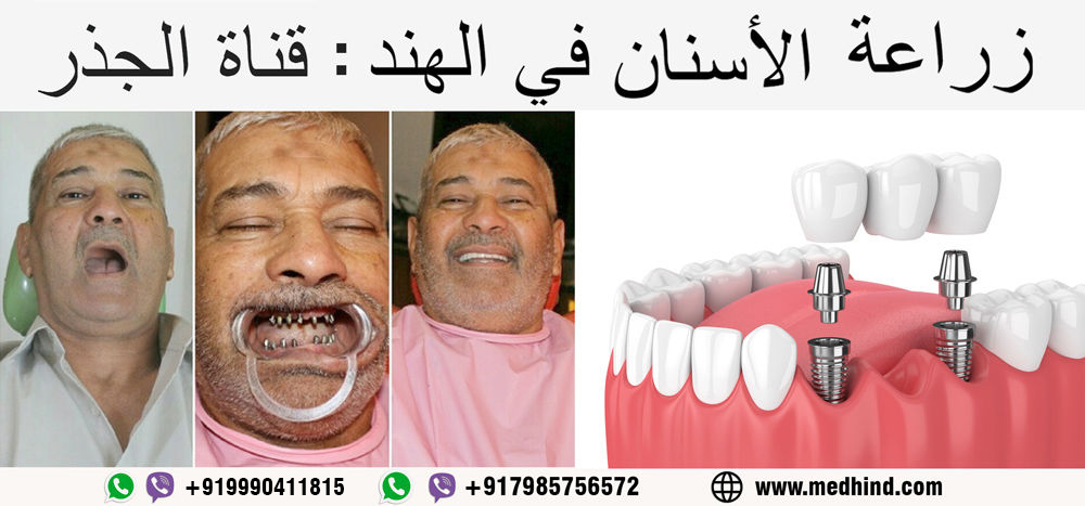 زراعة-الأسنان-في-الهند-وقناة-الجذر-في-الهند