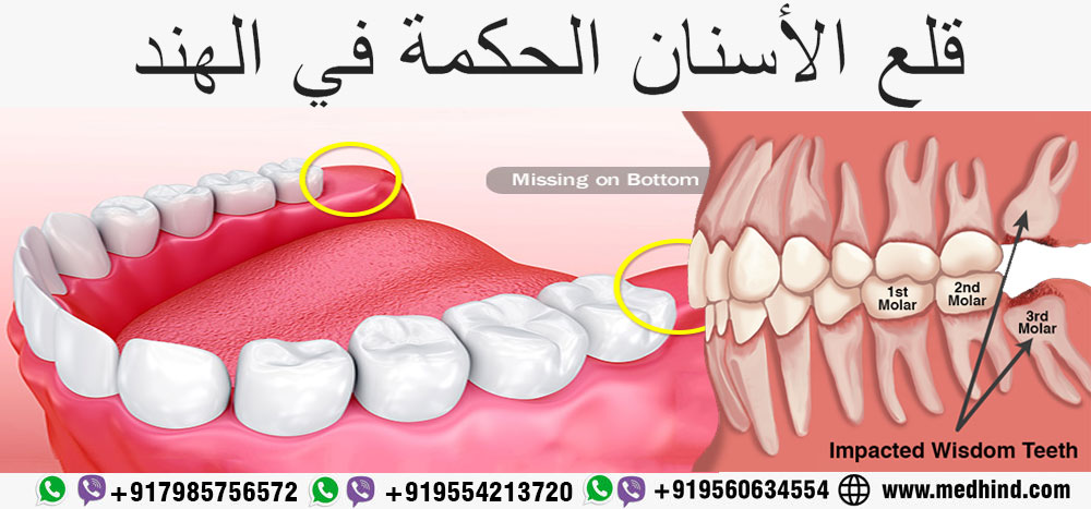 قلع-ضرس-العقل-الهند---قلع-ضرس-العقل-التكلفة-في-الهند