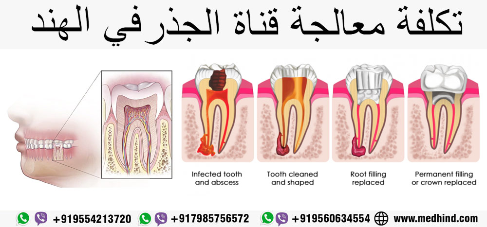 معالجة-قناة-الجذر-في-الهند