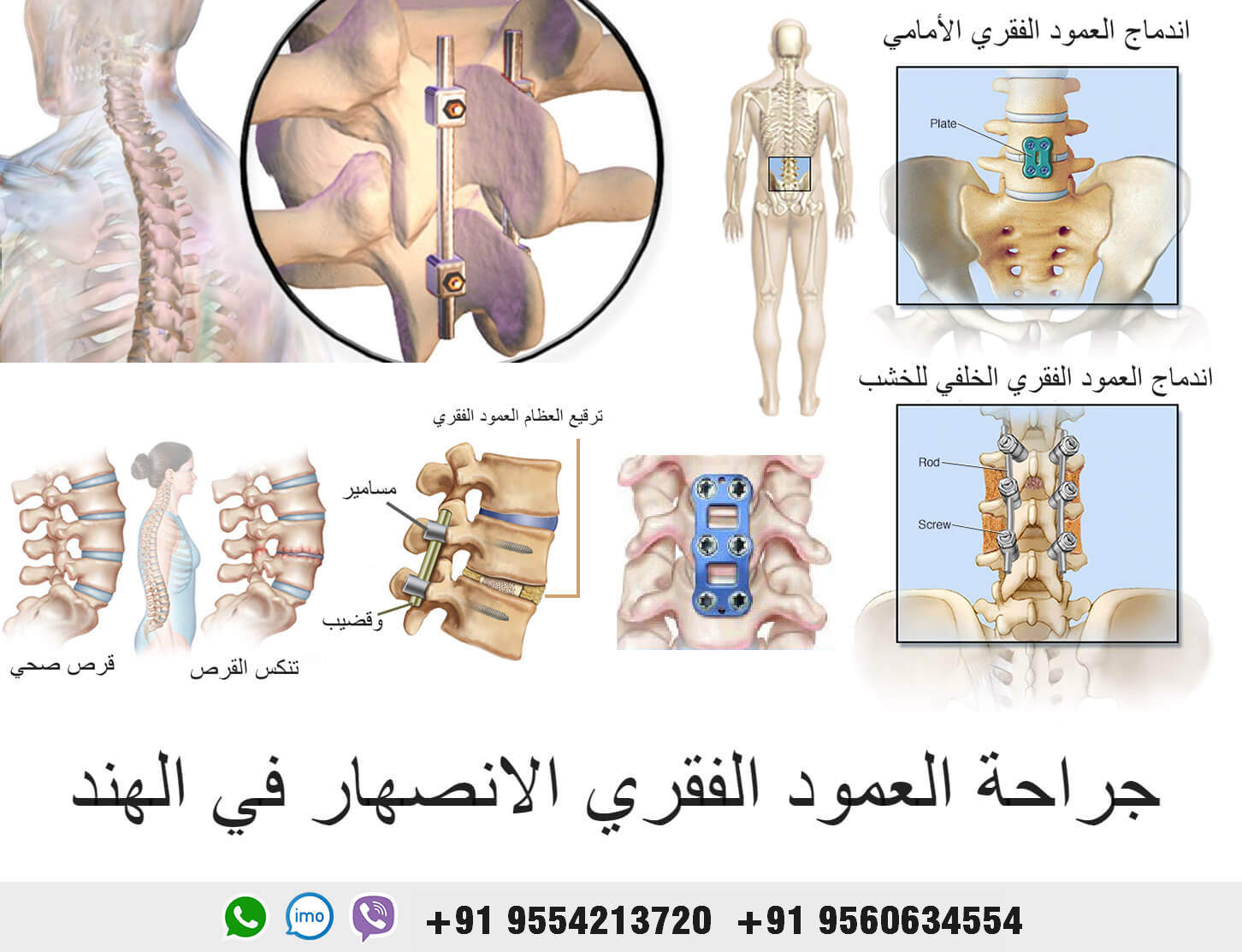Spine-fusion-surgery-in-india-1