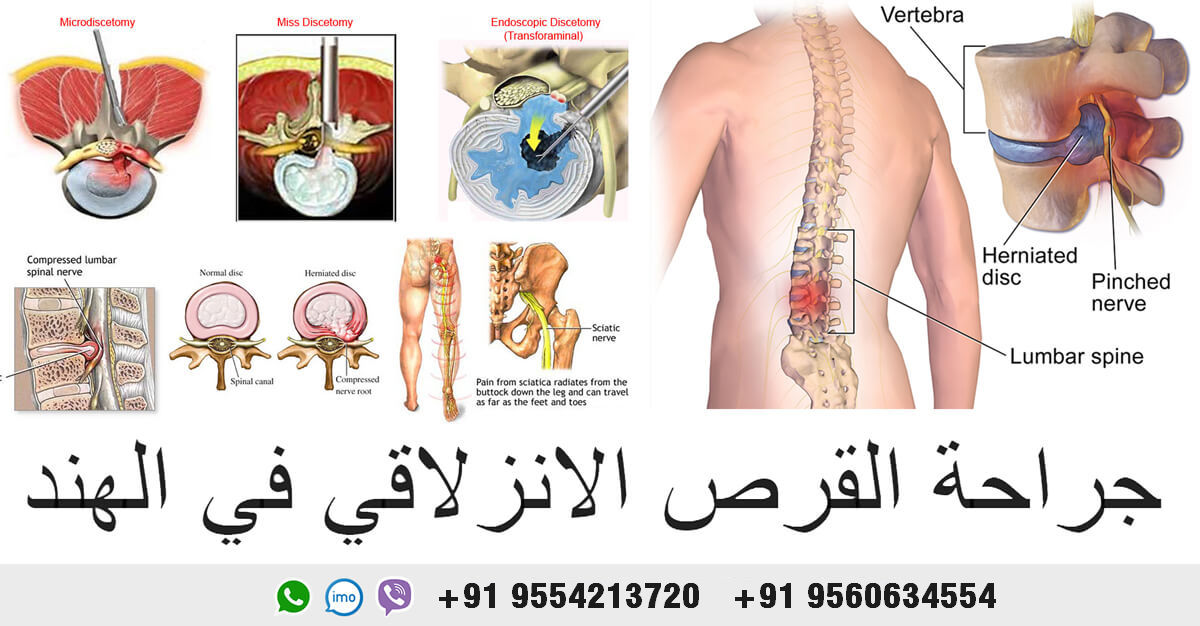 جراحة-القرص-الانزلاقي-في-الهند