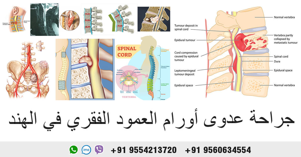 Spine-laser-surgery-India-spine-laser-surgery-in-India