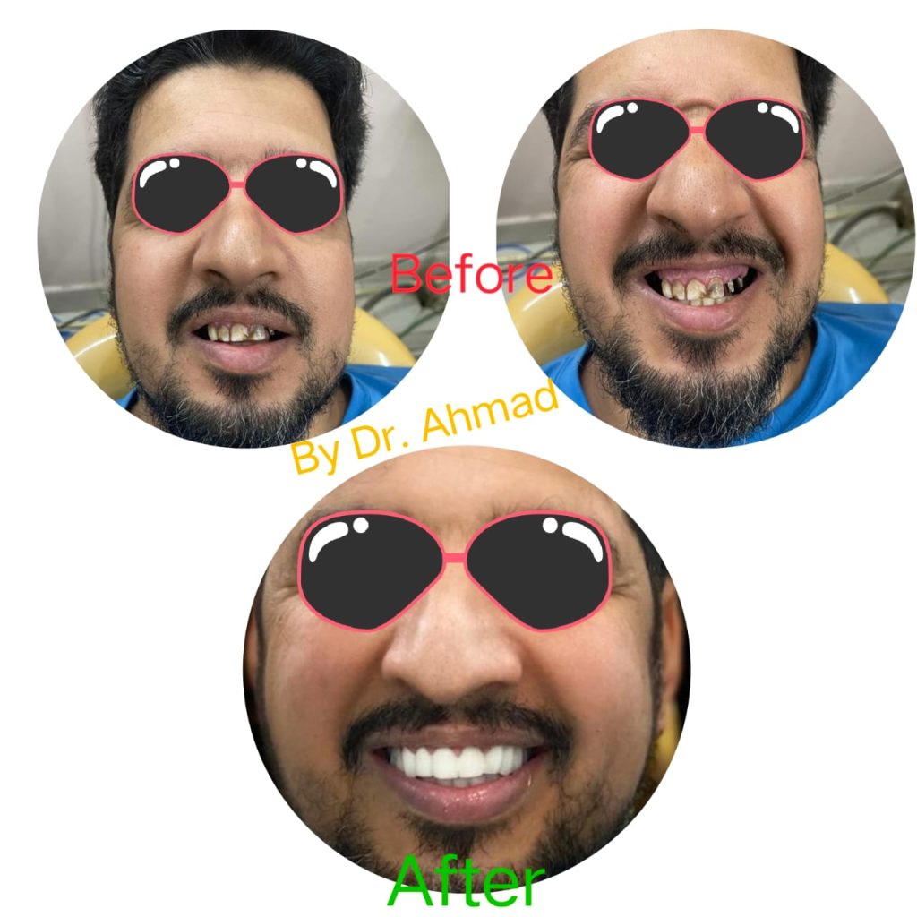 My experience with dental implants in India