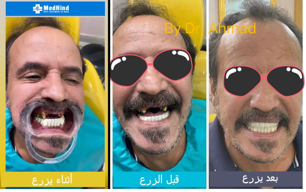 My experience with dental implants in India