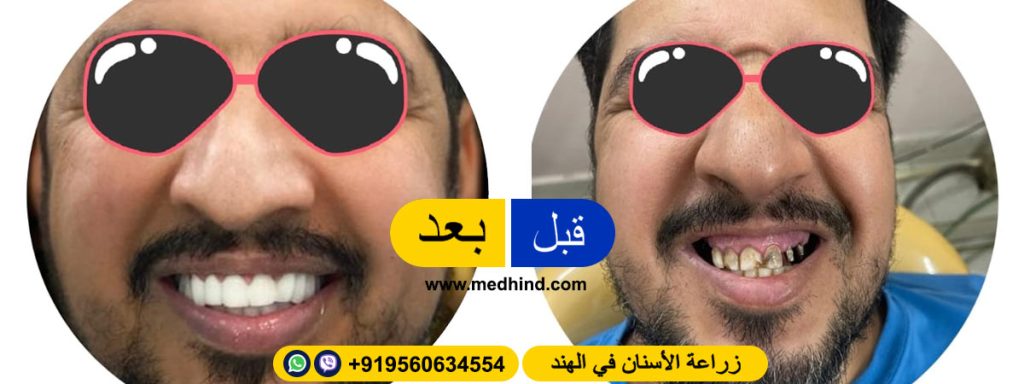 زراعة-الأسنان-في-الهند