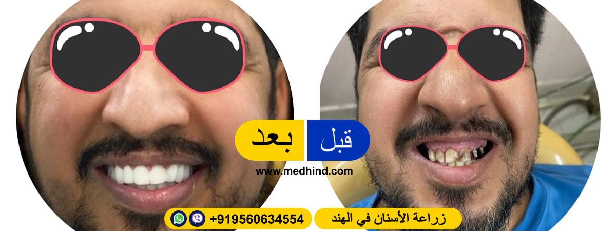 زراعة-الأسنان-في-الهند