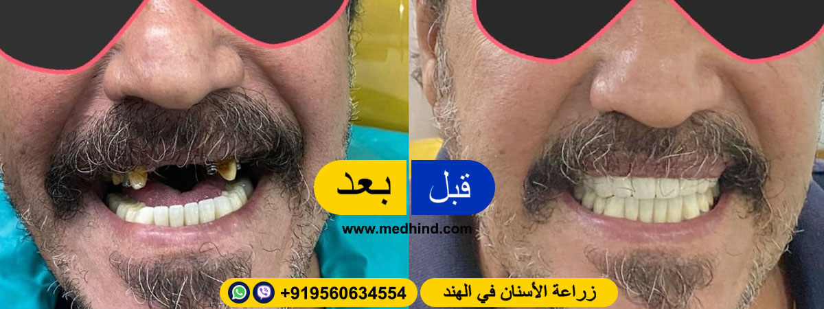 زراعة-الأسنان