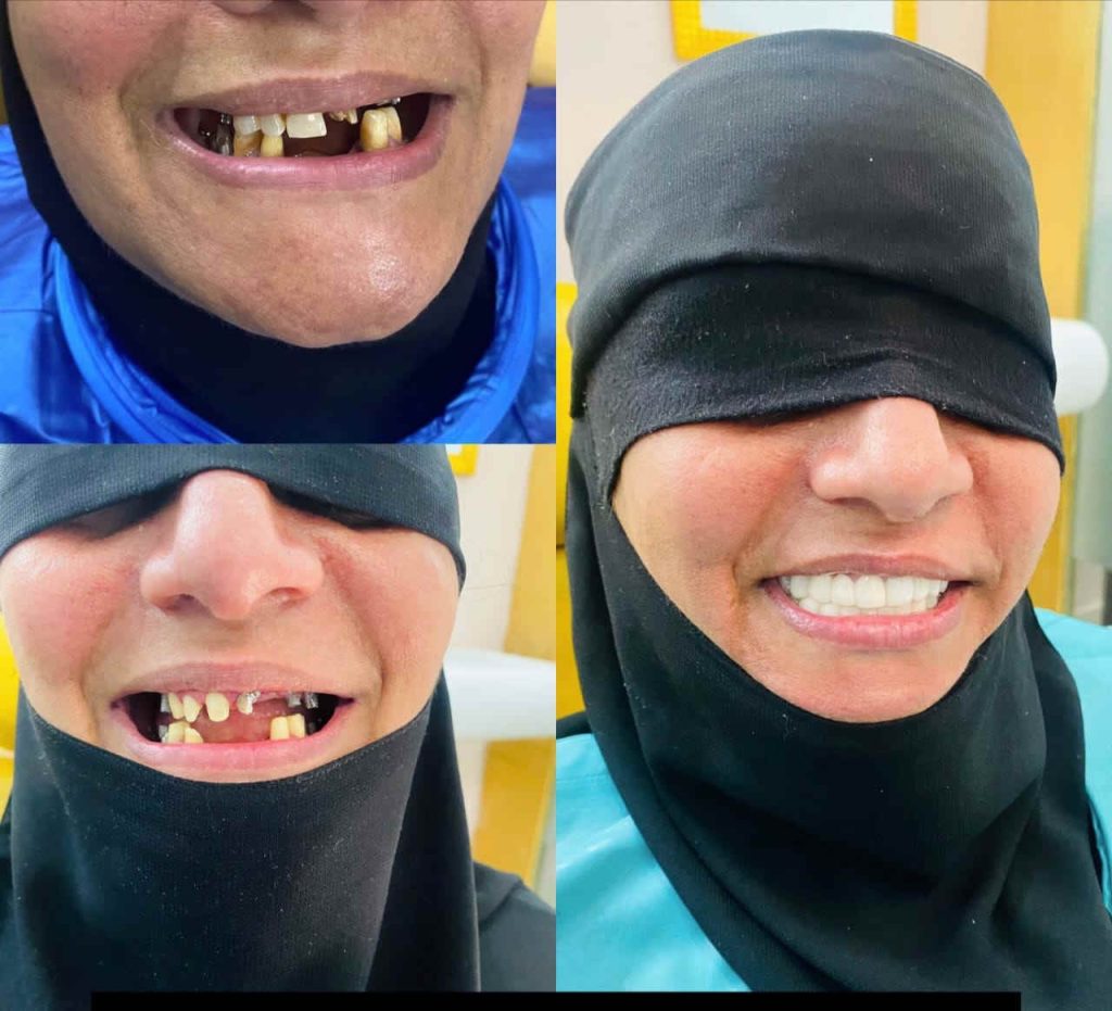 تجربتي في زراعة الأسنان في الهند