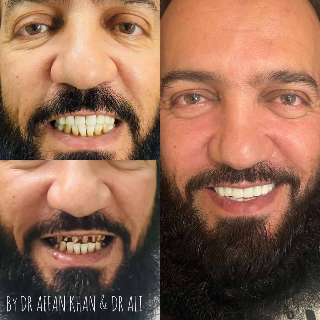 Dental Implants in India. تجربتي في زراعة الأسنان في الهند