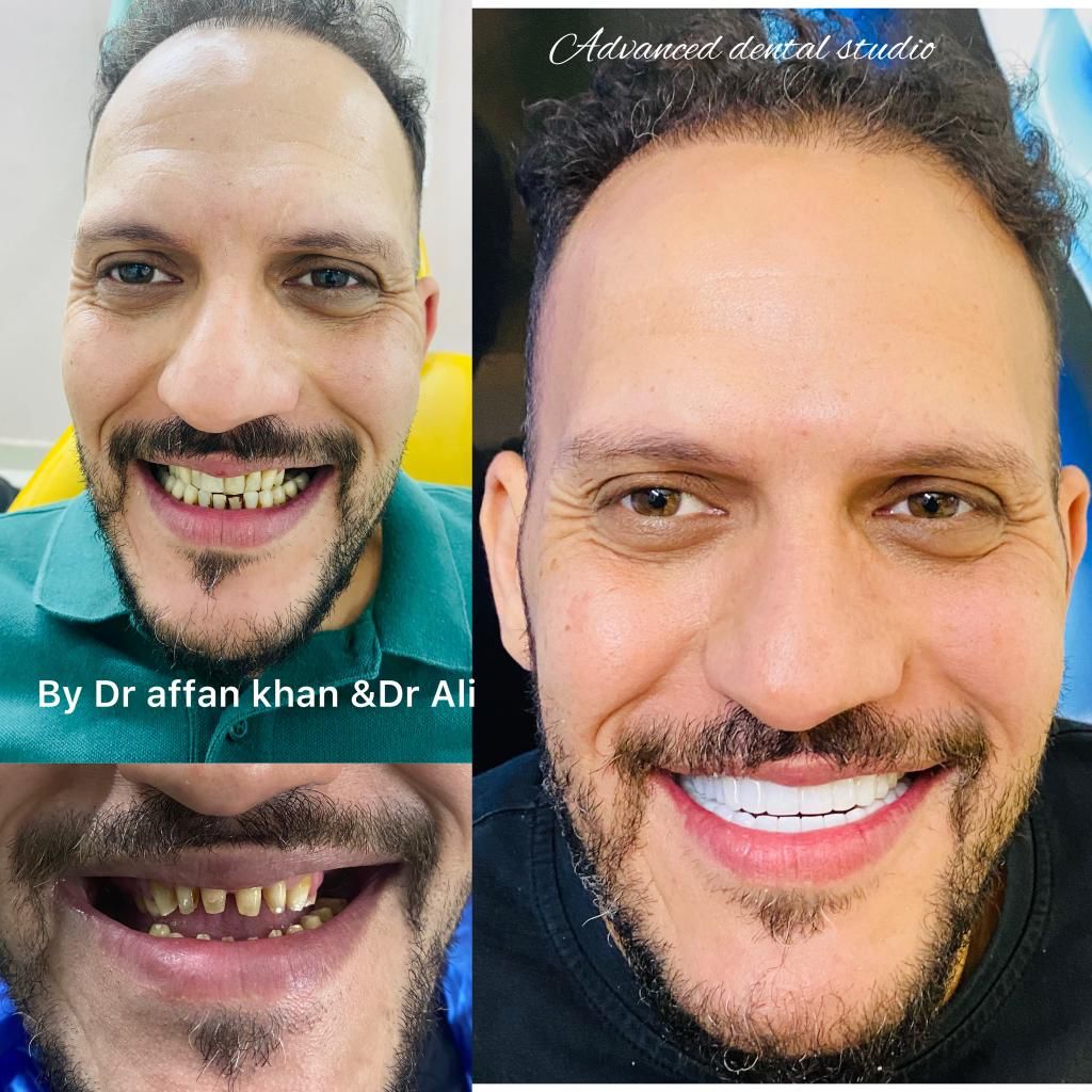 تجربتي في زراعة الاسنان