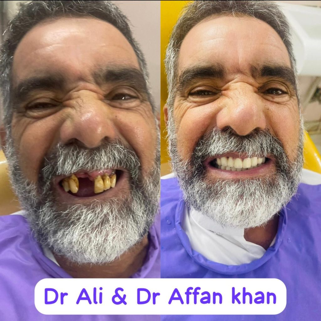 تجربتي مع زراعة الأسنان الفورية