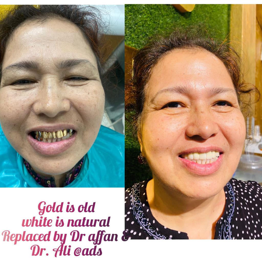 تجربتي مع زراعة الاسنان الهند