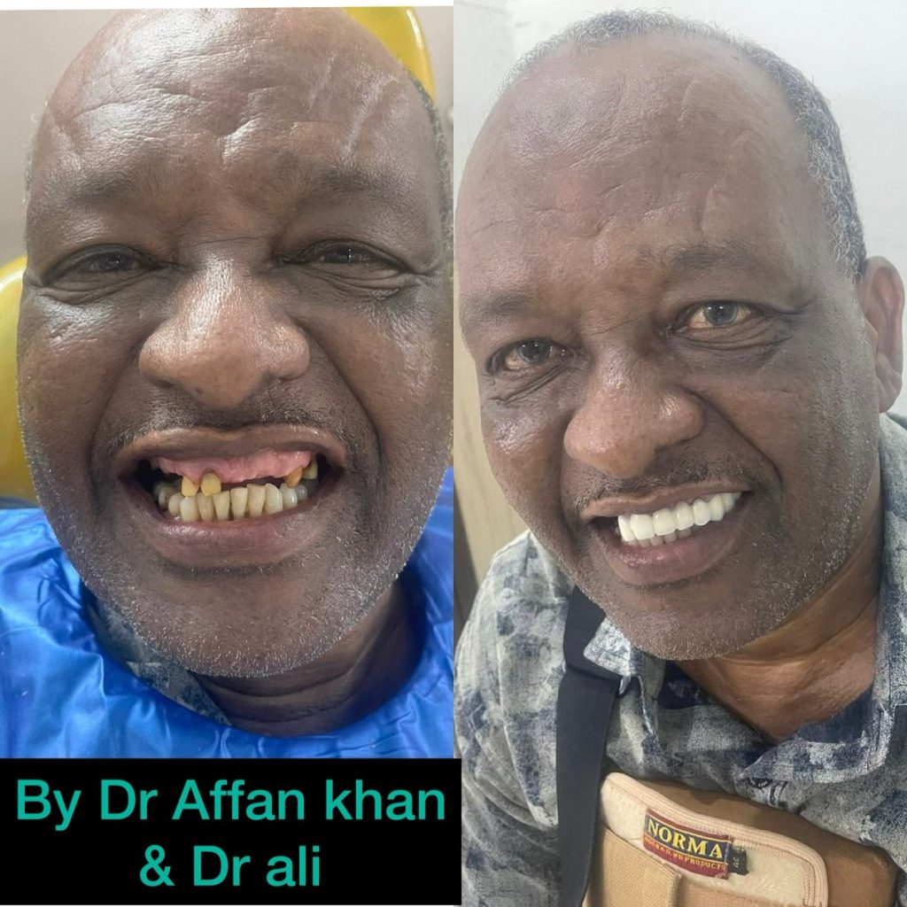 تجربتي مع زراعة الاسنان في الهند
