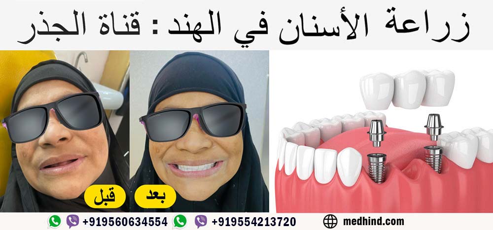 زراعة-الأسنان-في-الهند-وقناة-الجذر-في-الهند