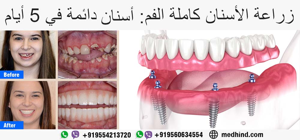 زراعة-الأسنان-كاملة-الف-أسنان-دائمة-في-5-أيام