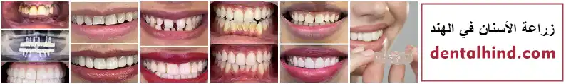 dentalhind - زراعة الأسنان في الهند